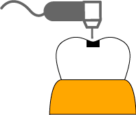 レジン充填治療むし歯疽削除